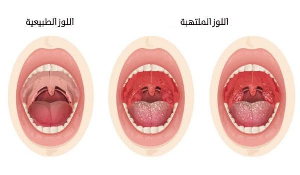 علاج التهاب اللوزتين للكبار