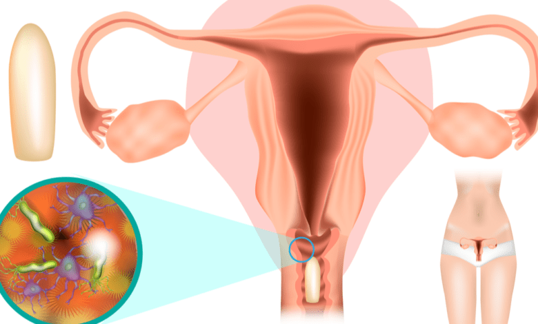 علاج التهابات المهبل للمتزوجات