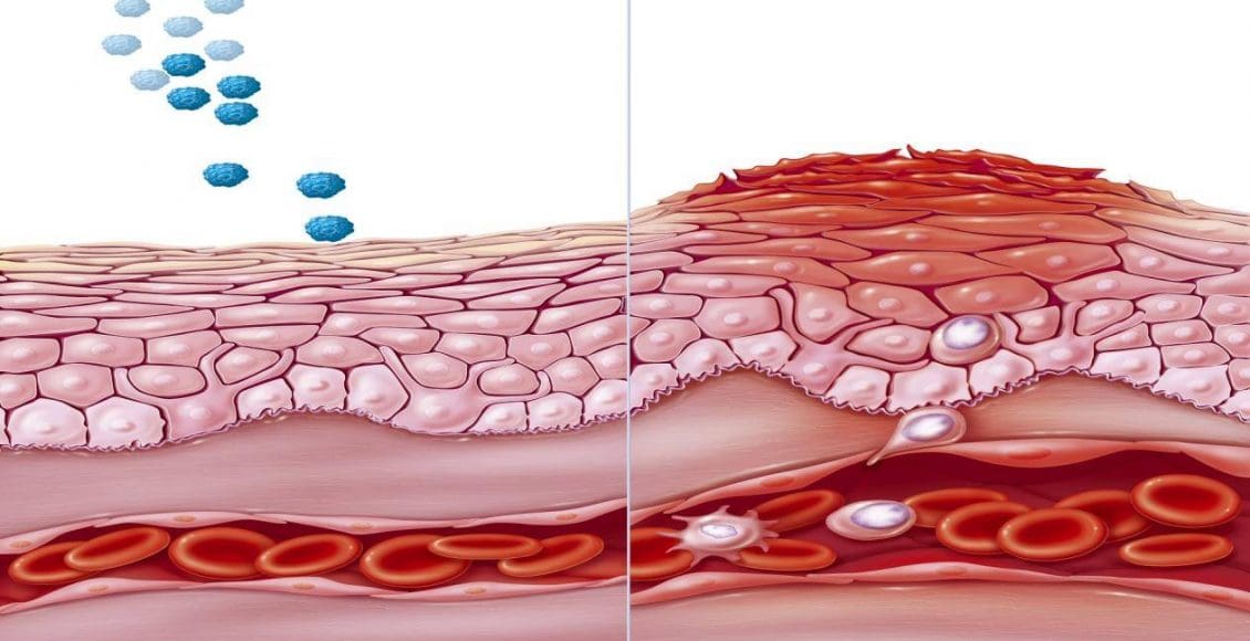 علاج الحكة الجلدية المزمنة