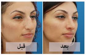 مراحل تغير الأنف بعد عملية التجميل