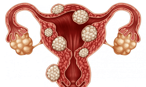 علاج تكيس المبايض بالأعشاب والطب النبوي