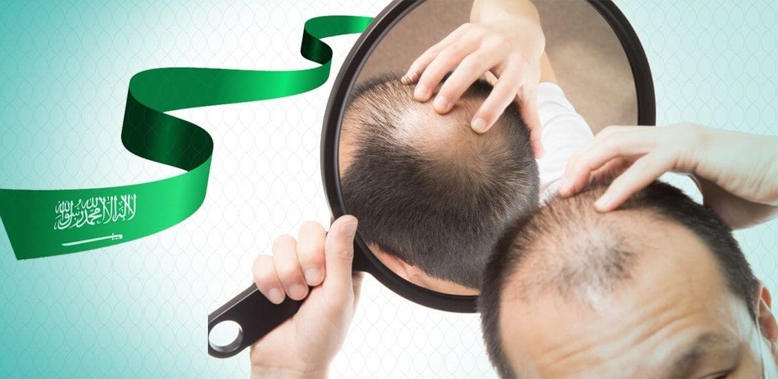 تكلفة زراعة الشعر في السعودية