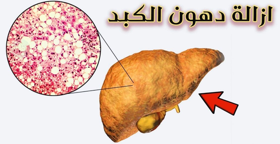 أسهل طريقة لإزالة دهون الكبد