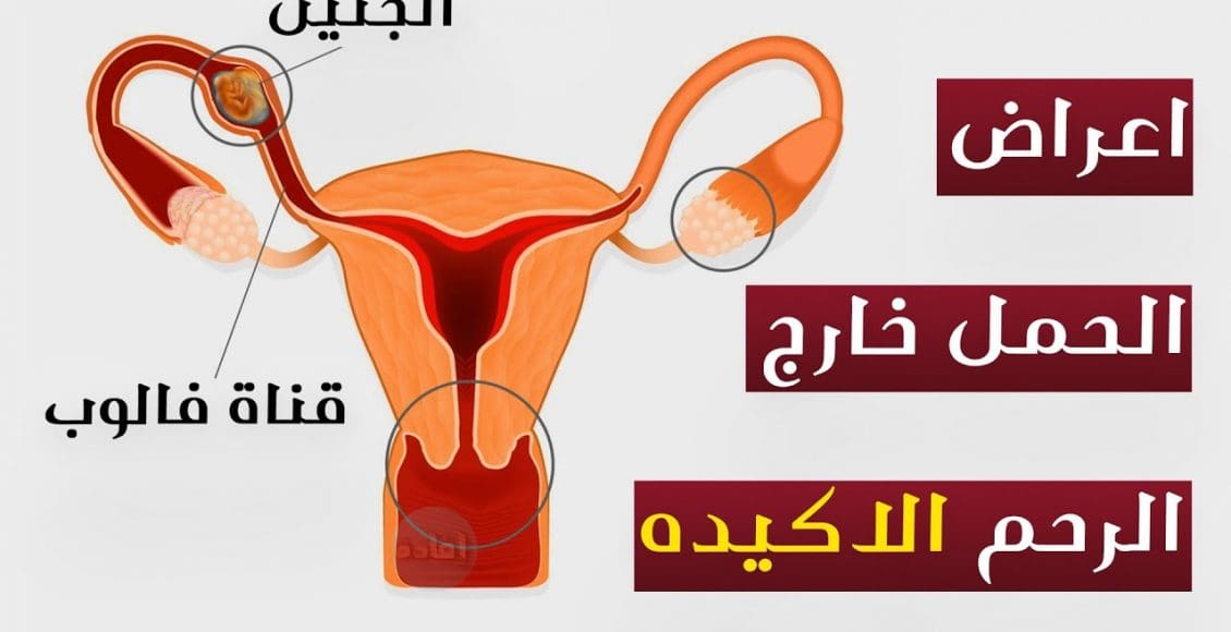 أعراض الحمل خارج الرحم الأكيدة