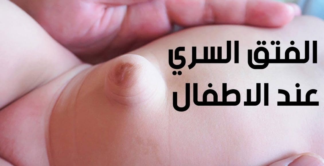 علاج السرة البارزة عند الاطفال