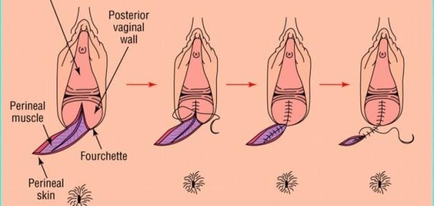 علاج الخياطة بعد الولادة الطبيعية