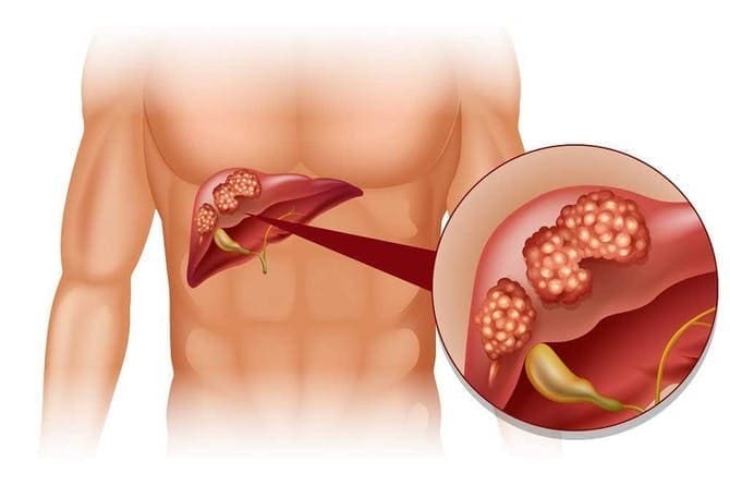 علاج دهون الكبد وزيت الزيتون وأعراضه وأسبابه