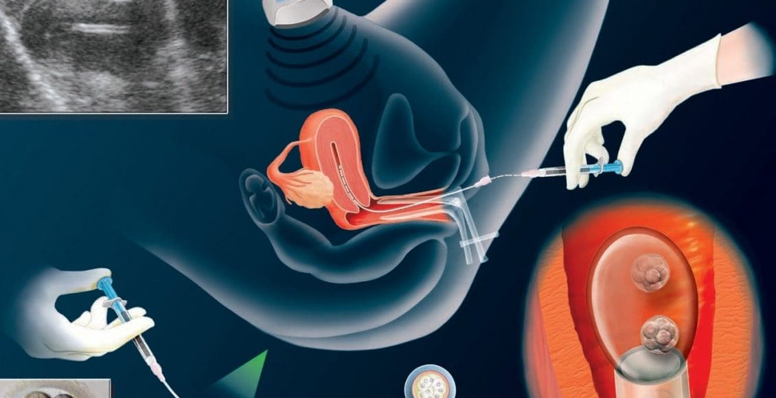 نصائح قبل الحقن المجهري بشهر
