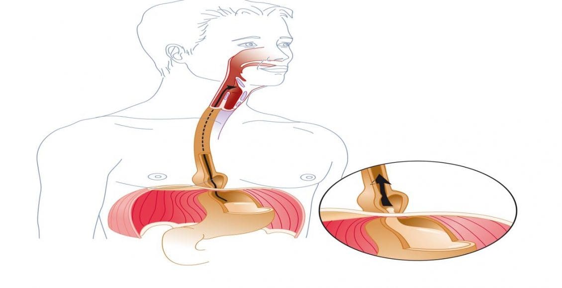 هل ارتجاع المريء يسبب الوفاة؟