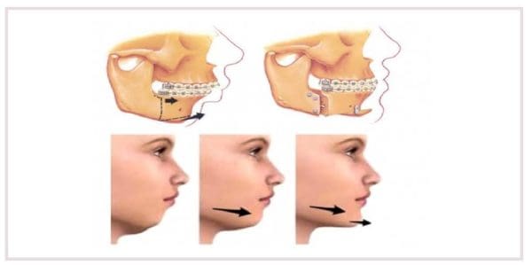 علاج الفك السفلي المتراجع بدون عملية