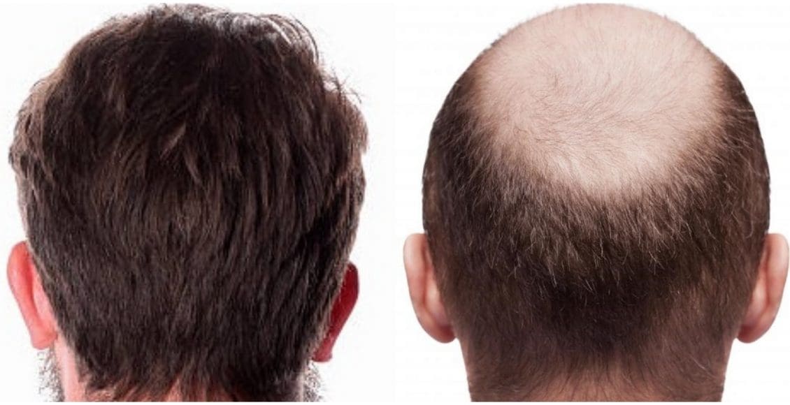 تجربتي مع زراعة الشعر