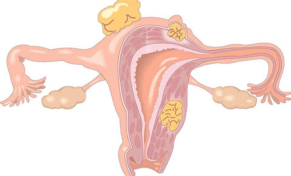 علاج تليف الرحم بالحلبة