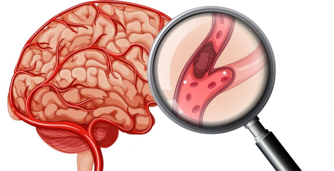 هل تؤثر الجلطة الدماغية على العقل؟