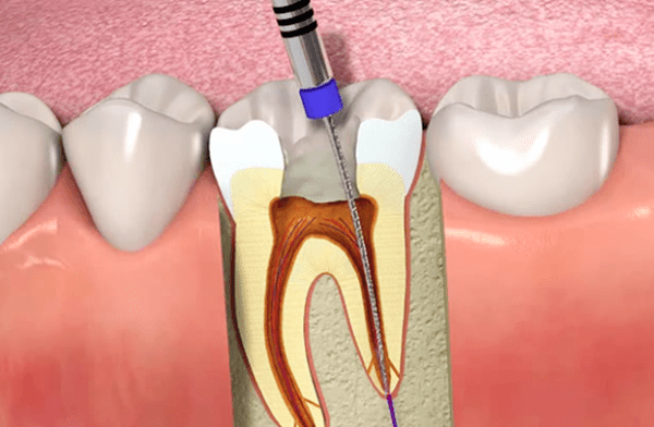 متى يحتاج الضرس سحب عصب؟