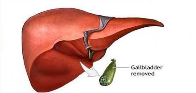 كيف يتم هضم الدهون بعد استئصال المرارة