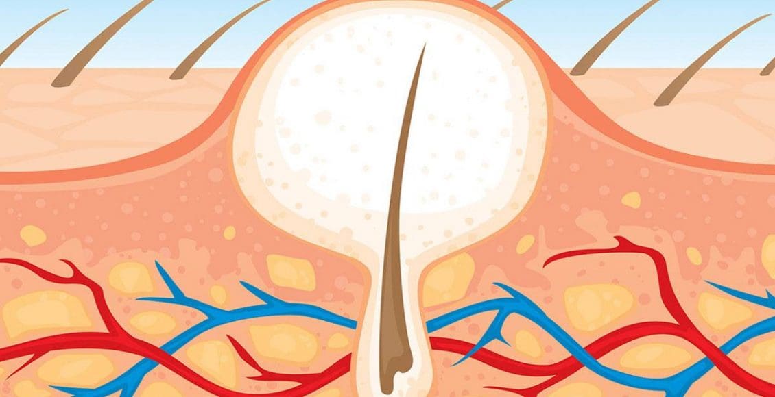 أفضل طريقة لإزالة الشعر من المناطق الحساسة نهائيًا