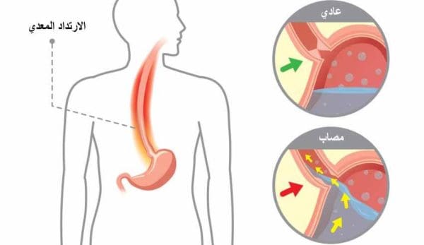 أفضل علاج لارتجاع المريء والتهاب المعدة في الصيدليات