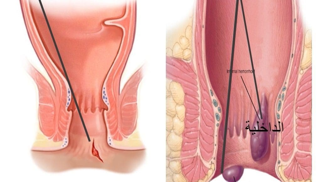 أفضل علاج للبواسير الملتهبة