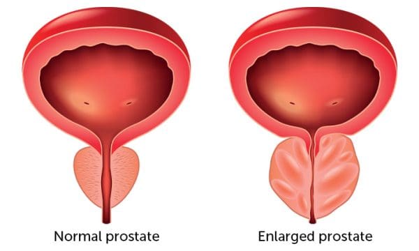 هل تضخم البروستاتا خطير