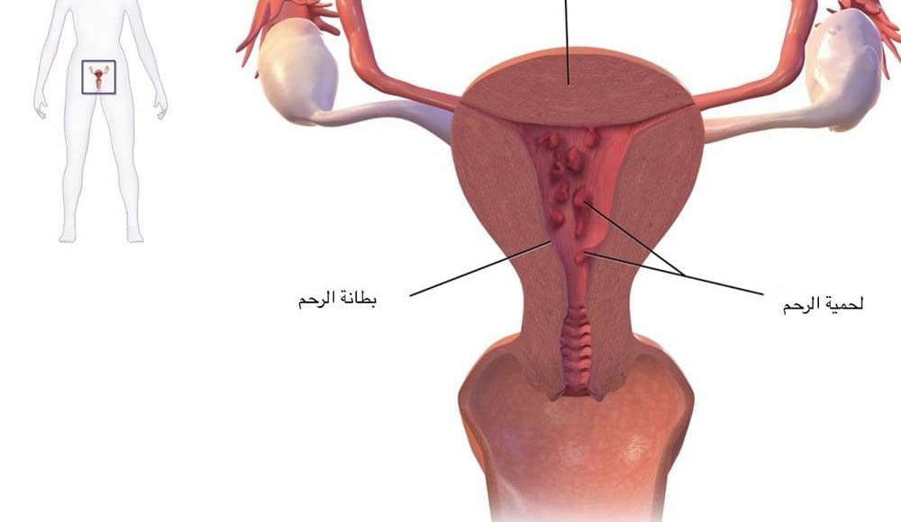 هل لحمية الرحم تنزل مع الدورة