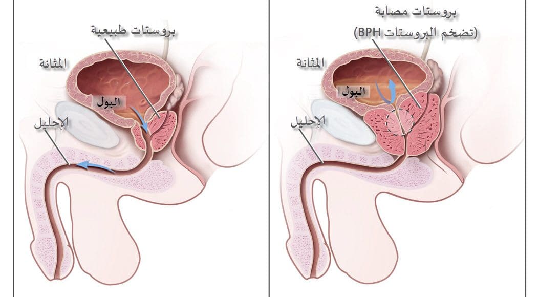 هل مرض البروستات خطير