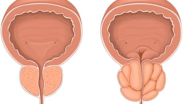 هل يمكن الشفاء من تضخم البروستاتا 
