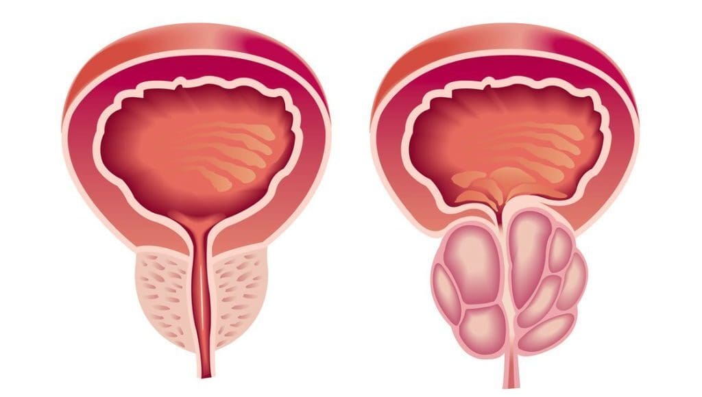 أسباب تضخم البروستاتا في سن مبكر