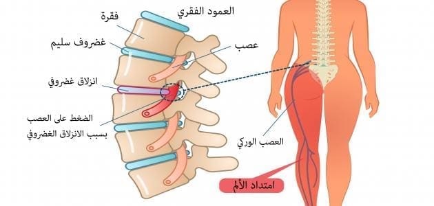 أسباب عرق النسا وعلاجه