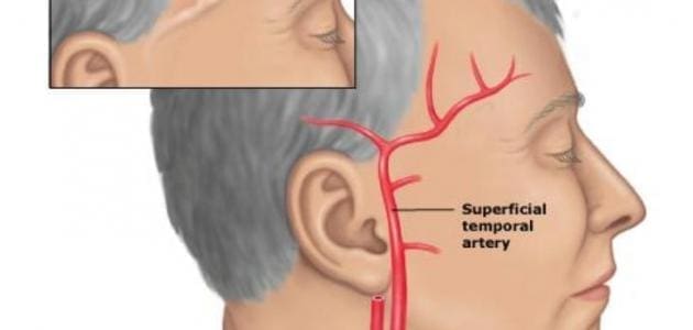 ما هي أسباب نبض عروق الرأس