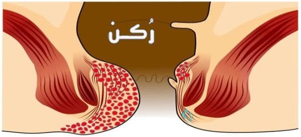 الفرق بين الناسور والبواسير