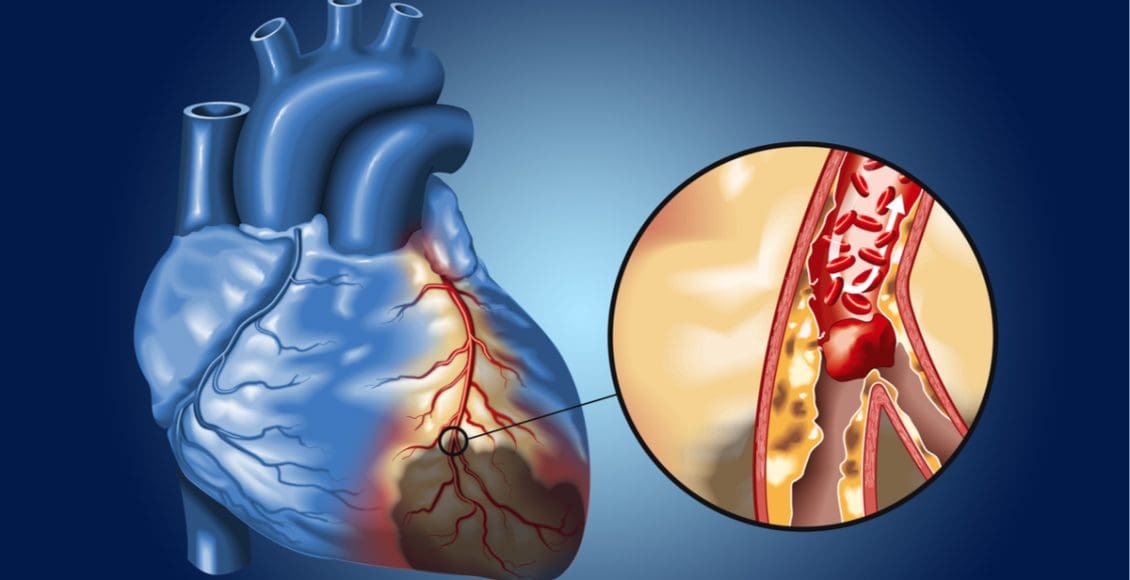 أسباب انسداد شرايين القلب