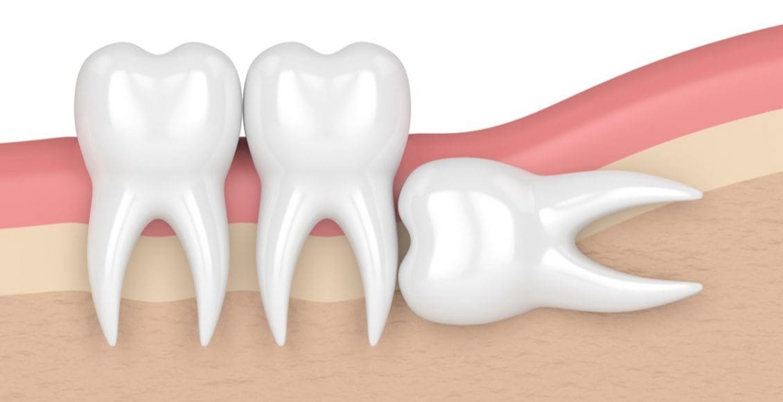 أعراض ضرس العقل المدفون