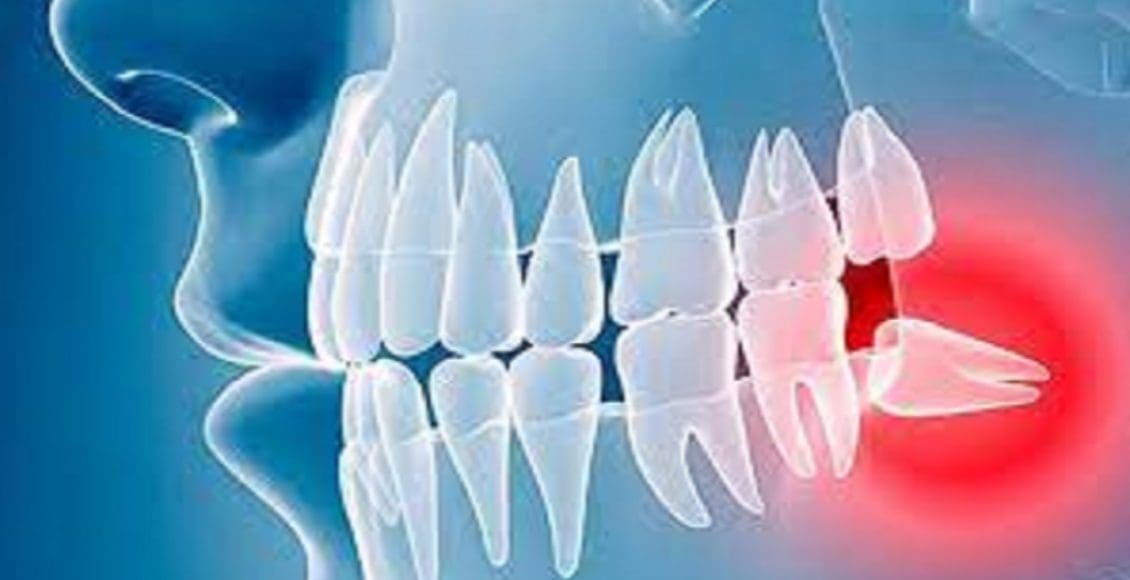 ظهور ضرس العقل بعد الثلاثين