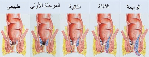 أعراض البواسير عند الرجال