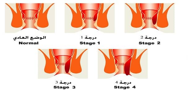 أخطر أنواع البواسير