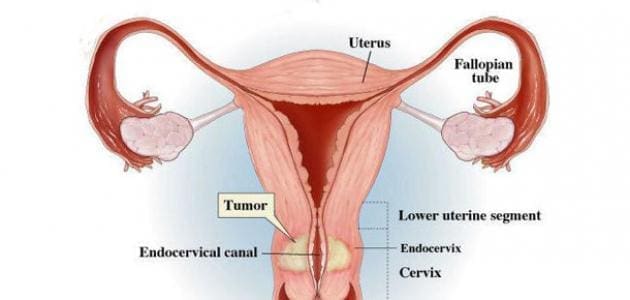 أعراض سرطان عنق الرحم