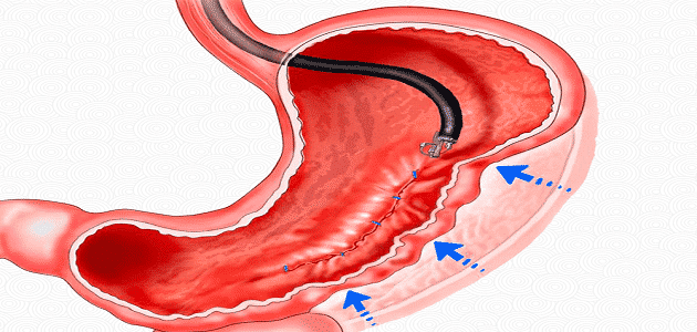 تكميم المعدة بدون جراحة