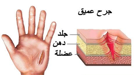 طريقة تنظيف الجروح بالصور