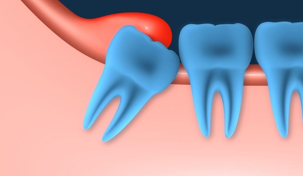 سبب ظهور ضرس العقل في سن 16