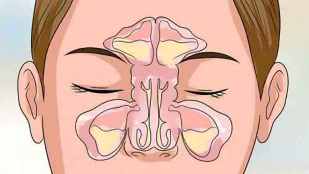 علاج الجيوب الأنفية للحامل بالأعشاب