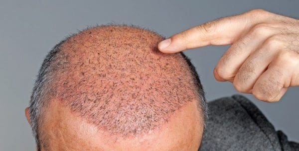 نتائج زراعة الشعر بعد 3 شهور