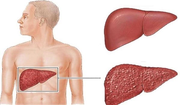 حالات شفيت من فيروس الكبد بي