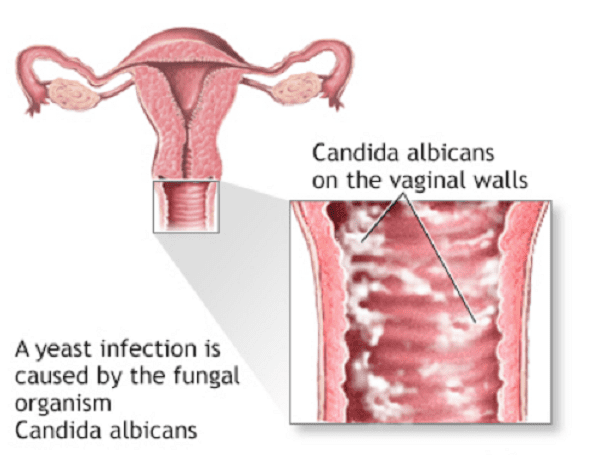 عدوى الخميرة المهبلية شكل فطريات المهبل بالصور