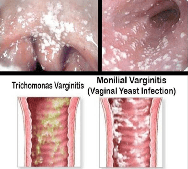 عدوى الخميرة المهبلية شكل فطريات المهبل بالصور