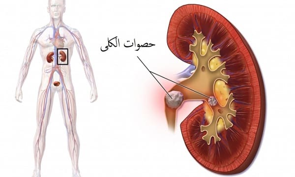 أضرار تفتيت الحصوات بالموجات التصادمية