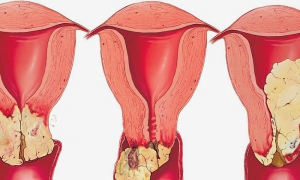 عدوى الخميرة المهبلية شكل فطريات المهبل بالصور